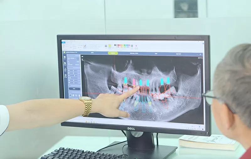 Overseas Vietnamese should send CT scans before returning home so that experts can plan the implant placement, estimate costs, and treatment time. Overseas Vietnamese should send CT scans before returning home so that experts can plan the implant placement, estimate costs, and treatment time.