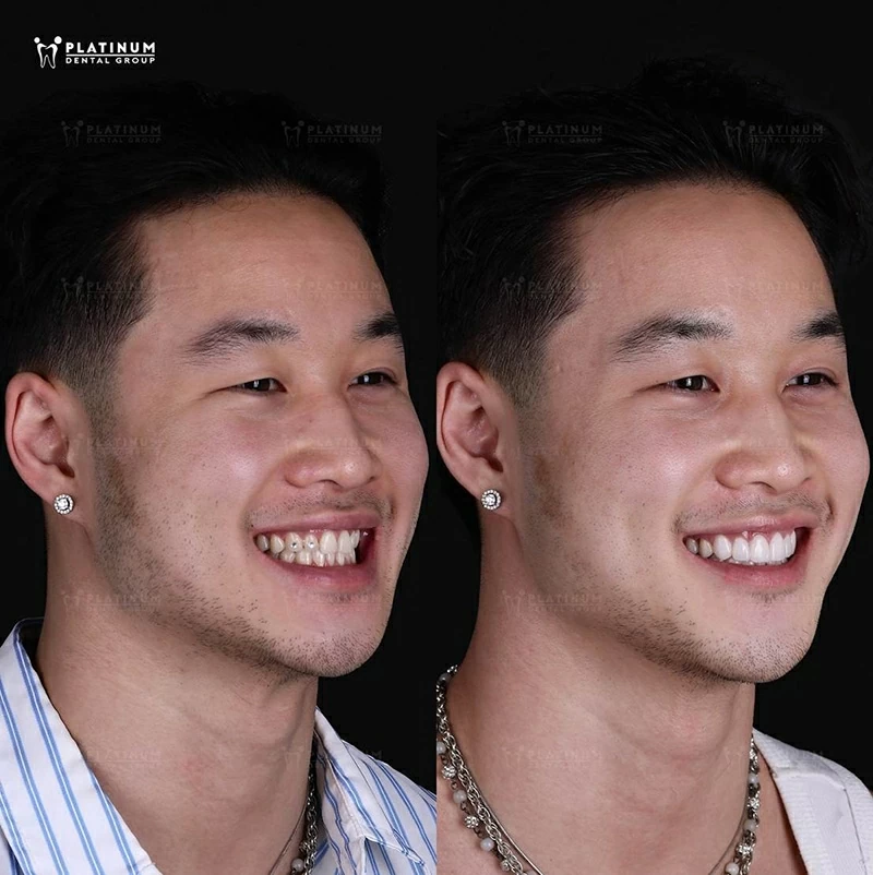 Crowns improve appearance while restoring function and long-term stability.