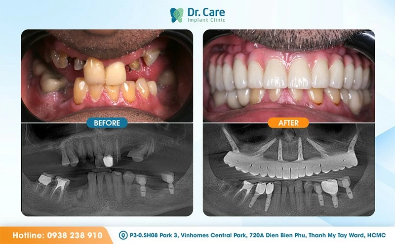 A patient before All-on-4 surgery (left) and after receiving a fixed full-arch prosthesis at Dr. Care Implant Clinic (right). Facial volume and lip support are restored within days of the procedure, while osseointegration continues over three to six months.