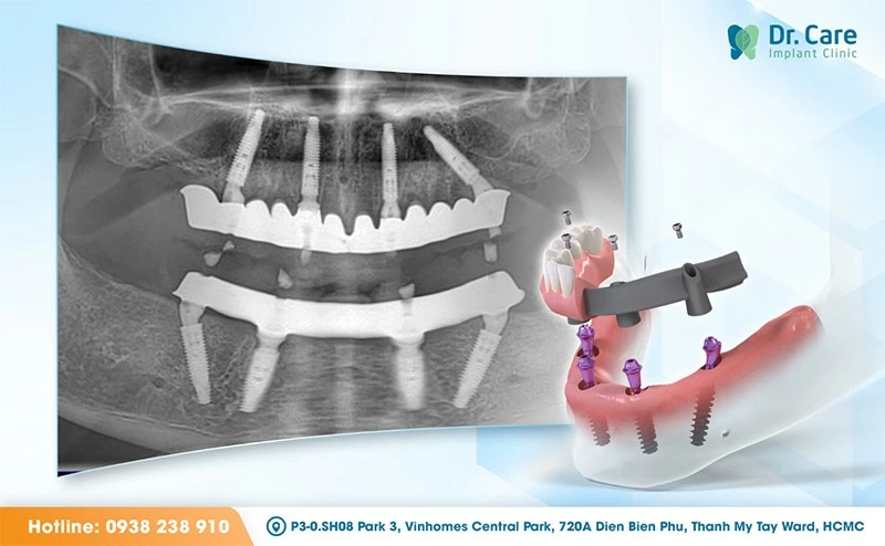 Cross-section diagram of an All-on-4 configuration: two vertical anterior implants and two posterior implants angled at approximately 45 degrees, supporting a fixed full-arch prosthesis. The angled placement maximises engagement with the available anterior and lateral bone without requiring posterior bone grafting. Cross-section diagram of an All-on-4 configuration: two vertical anterior implants and two posterior implants angled at approximately 45 degrees, supporting a fixed full-arch prosthesis. The angled placement maximises engagement with the available anterior and lateral bone without requiring posterior bone grafting.