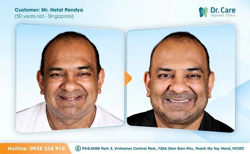 Facial profile before All-on-4 surgery (left) and after temporary prosthesis placement at Dr. Care Implant Clinic (right). The fixed temporary restoration restores facial support and chewing function while osseointegration — the biological fusion of implant and bone — takes place over three to six months. Facial profile before All-on-4 surgery (left) and after temporary prosthesis placement at Dr. Care Implant Clinic (right). The fixed temporary restoration restores facial support and chewing function while osseointegration — the biological fusion of implant and bone — takes place over three to six months.