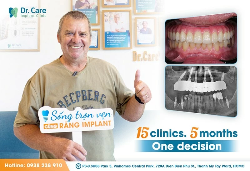 International patient Mr. Norbert Eberhardt, following combined implant and veneer rehabilitation at Dr. Care, performed by Dr. Nguyen Trung Khanh and Dr. Vo Huyen Bao Tran. The case required coordinated surgical and prosthetic planning across two phases — completed to a result the clinical team described as restoring The specialists behind the technology: Meet Dr. Care’s specialized implant team