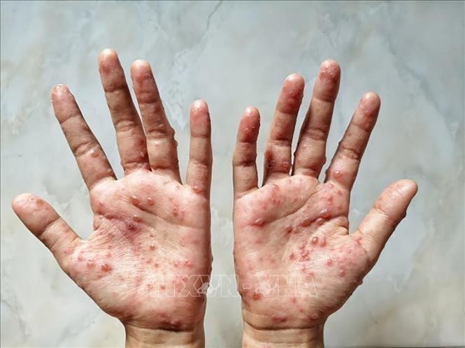 Health Ministry recommends measures to prevent monkeypox. (Photo: VNA)